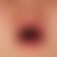 Lupus erythematodes, systemischer: Detailaufnahme
