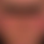 Lupus erythematosus systemic: fixed (persistent), relatively sharply defined, deep red, "butterfl...