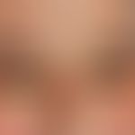 Xanthelasma: exzessiver Befund. Breitbasig aufsitzende, symptomlose, gelbe, weiche Plaques und Kn...