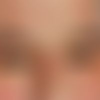 Xanthelasma: exzessiver Befund. Breitbasig aufsitzende, symptomlose, gelbe, weiche Plaques und Kn...
