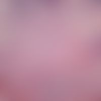 Xanthelasma:&nbsp;ballenförmige Durchsetzung der mittleren Dermis, durch Konvolute heller Zellen ...