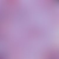 Xanthelasma:Detailvergrößerung: Konglomerat von Schaumzellen mit großen, optisch leeren Vakuolen ...
