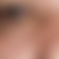 Xanthelasma. 63 Jahre alter Patient mit bekannter Hyperlipidämie. Die bestehende Hautläsion entwi...