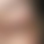 Xanthelasma. Bei der 45-jährigen Patientin bestehen flächige, weiche, weiß-gelbe, streifenförmige...