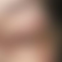 Xanthelasma. Bei der 45-jährigen Patientin bestehen flächige, weiche, weiß-gelbe, streifenförmige...