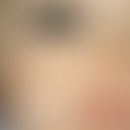 Xanthogranuloma, juveniles (sensu strictu): Solitary, softly elastic, yellowish, 1 x 3 cm large k...