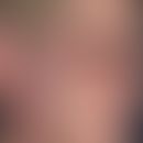 Xanthogranulom, nekrobiotisches mit Paraproteinämie. Bei der 62-jährigen Patientin zeigen sich me...