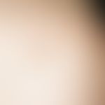 Xanthomas, tuberous. soft, yellowish, papular and nodular tuberous xanthomas on the shoulder in h...