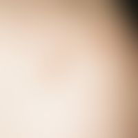 Xanthomas, tuberous. soft, yellowish, papular and nodular tuberous xanthomas on the shoulder in h...