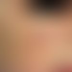 Xeroderma pigmentosum. Fleckig-schmutzige Pigmentierungen sonnenbelichteter Areale an der Wange. ...