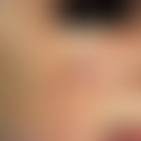 Xeroderma pigmentosum. Fleckig-schmutzige Pigmentierungen sonnenbelichteter Areale an der Wange. ...