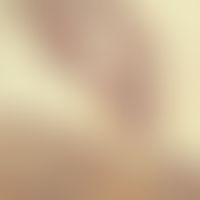 Zeckenstich:&nbsp;Zecke beim Saugakt. Dichtes rundzelliges Infiltrat um die Stichstelle.
