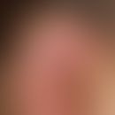 Perichondritis der Ohrmuschel. Im Bereich der Helix schmerzhafte, ödematöse, livide Schwellung be...