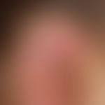 Perichondritis of the auricle, in the area of the helix painful, edematous, livid swelling with e...