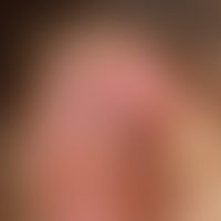Perichondritis of the auricle, in the area of the helix painful, edematous, livid swelling with e...