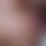 Perlèche. whitish, erosive papules in the area of the right corner of the mouth with deep reachin...