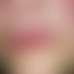 Perlèche. discreetly reddened plaques with mild erosions and scaling (Cheilitis atopica). central...