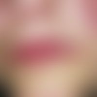 Perlèche. Diskret gerötete Plaques mit milden Erosionen und Schuppung (Cheilitis atopica). Zentra...