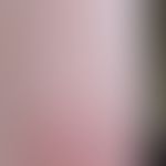 Perniosis follicularis: pinhead-sized, follicular, reddened papules (type rusticanus) in the area...