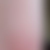 Perniosis follicularis: pinhead-sized, follicular, reddened papules (type rusticanus) in the area...