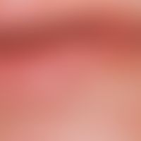 Peutz-Jeghers-Syndrom. DD: solare Lentiginose der Lippe. Die im späten Lebensalter erworbenen Len...