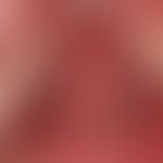Phlebektasia of the tongue, distinct, varicose dilatation of the veins of the tongue with attache...