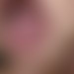 Phlebektasia. solitary, chronically stationary, flatly bulging at the lateral edge of the tongue,...