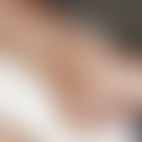 Phospholipid-Antikörper-Syndrom. Im Bereich des Unterschenkels und der Knöchelregion einer 35-jäh...