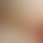 Phospholipid-antibody syndrome: Section of the nail fold of a 27-year-old woman with phospholipid...