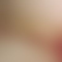 Phospholipid-antibody syndrome: Section of the nail fold of a 27-year-old woman with phospholipid...