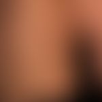 Piebaldism, congenital, garland-shaped and striped depigmentation that is aligned with the Blasch...