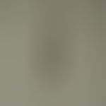 Monilethrix syndrome: Strangely shimmering (due to different reflections of light in the twisted ...
