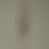 Monilethrix syndrome: Strangely shimmering (due to different reflections of light in the twisted ...