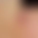 Pilomatrixom:&nbsp;rötlich-brauner, kalottenförmiger, gegenüber der Unterlage verschieblicher, sc...