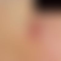 Pilomatrixom:&nbsp;rötlich-brauner, kalottenförmiger, gegenüber der Unterlage verschieblicher, sc...