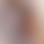 Pilomatrixom -Auflichtmikroskopie: bläulich-opake und gelblich-weiße Plaques (Kalzifikationsherde...