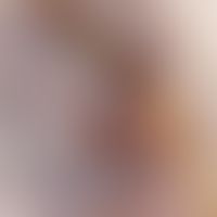 Pilomatrixom -Auflichtmikroskopie: bläulich-opake und gelblich-weiße Plaques (Kalzifikationsherde...