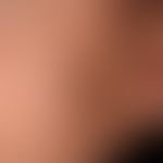 Pilomatrixom:&nbsp;langsam wachsender flach sich vorwölbender, schmerzloser Knoten der seit 1 Jah...