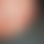 Pincer-nail:&nbsp; zangenartige Verformung aller Zehennägel. Der Befall aller Zehennägel läßt auf...