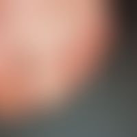 Pincer-nail:&nbsp; zangenartige Verformung aller Zehennägel. Der Befall aller Zehennägel läßt auf...