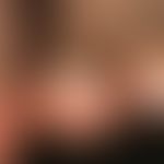Pincer-nail: Nahaufnahme mit erheblicher Querverbiegung der Zehennägel mit schmerzhafter Umfassun...