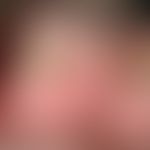 Pincer-nail: Detailvergrößerung: Extreme,nahezu&nbsp;röhrenförmige Querverbiegung der Zehennägel ...