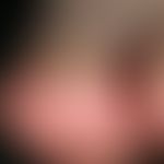 Pincer-nail: röhrenförmige Zangenform des linken Großzehennagels mit schmerzhaftem Einschneiden i...