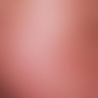 Pityriasis lichenoides chronica, close-up, excised or ulcerated hemorrhagic papules up to 4 mm in...
