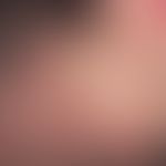 Pityriasis lichenoides et varioliformis acuta: Acute (since 4-5 weeks) papular exanthema after fe...