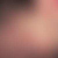 Pityriasis lichenoides et varioliformis acuta: Acute (since 4-5 weeks) papular exanthema after fe...