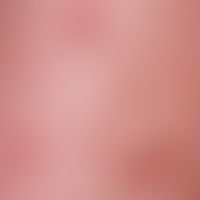 Pityriasis lichenoides et varioliformis acuta, detail view: haemorrhagic papules, isolated eroded...
