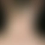 Pityriasis lichenoides et varioliformis acuta. multiple, acute, disseminated, 0.2-0.4 cm large, m...