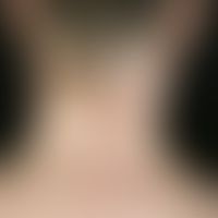 Pityriasis lichenoides et varioliformis acuta. multiple, acute, disseminated, 0.2-0.4 cm large, m...