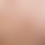 Pityriasis lichenoides et varioliformis acuta. acutely occurring "colorful" exanthema after febri...